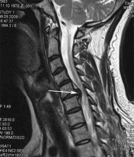 Spinal cord injury triggers neck pain
