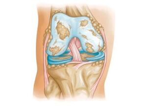 knee joint damage with osteoarthritis