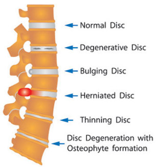 a variety of damage to the disc of the spine